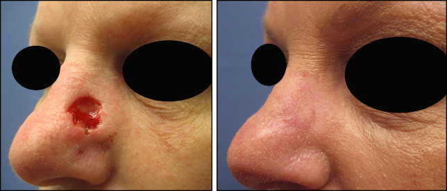 facelift